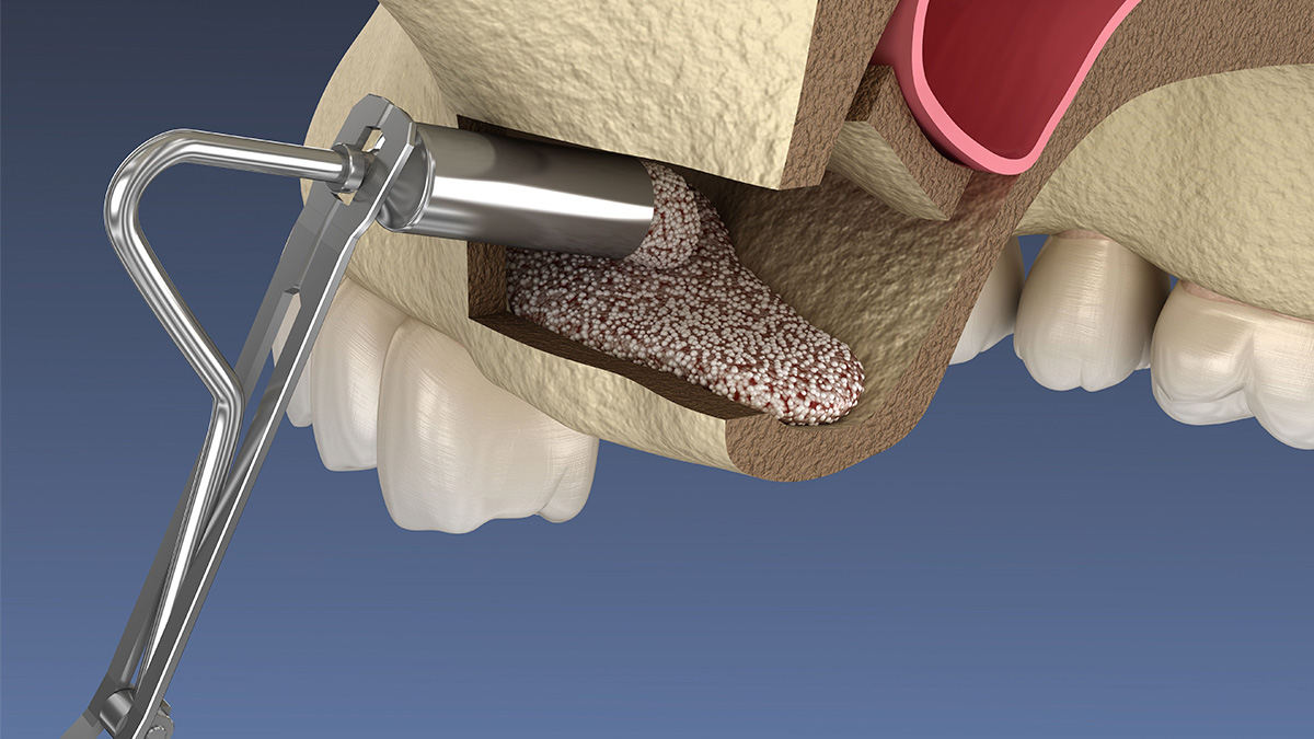 Sinus Lift Sinus Lifting Procedure Dentelin