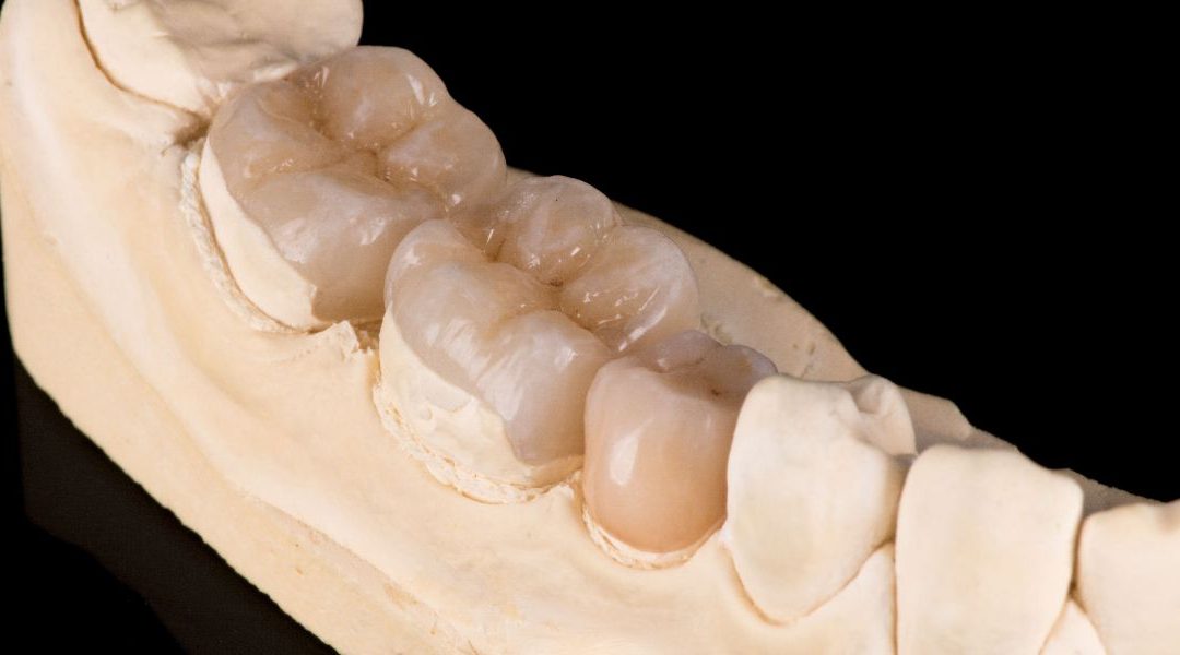 Inlay, Onlay, Overlay: kada koji nadomjestak odabrati i zašto