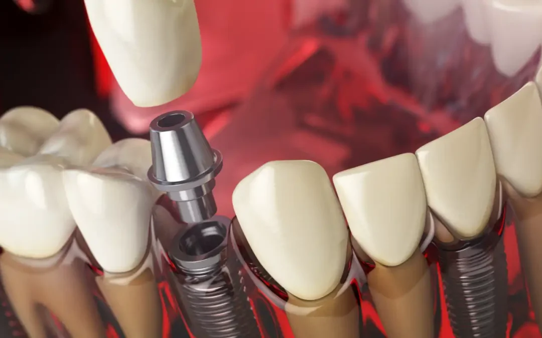 Što je Abutment (suprastruktura ili prijelazni element) kod dentalnog implantata?