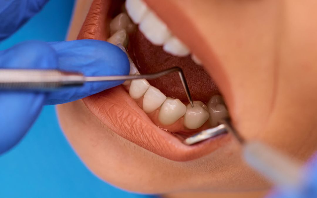 Gingivitis – simptomi i liječenje