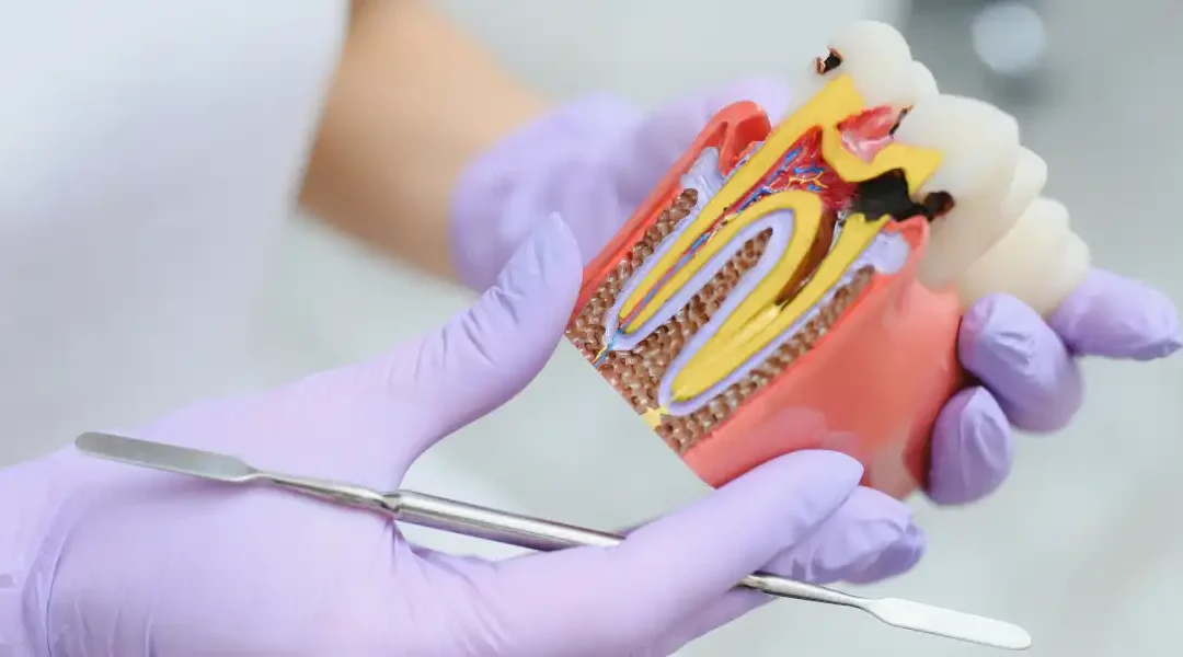 5 savjeta kako spriječiti nastanak karijesa