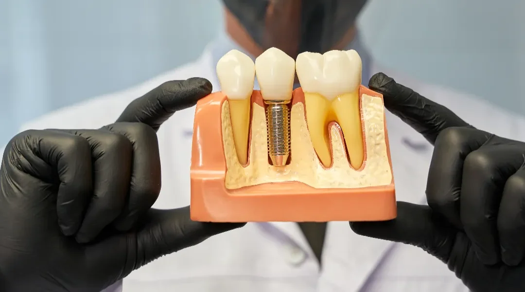 Mogu li se titanski zubni implantati smatrati bio implantatima nove generacije?