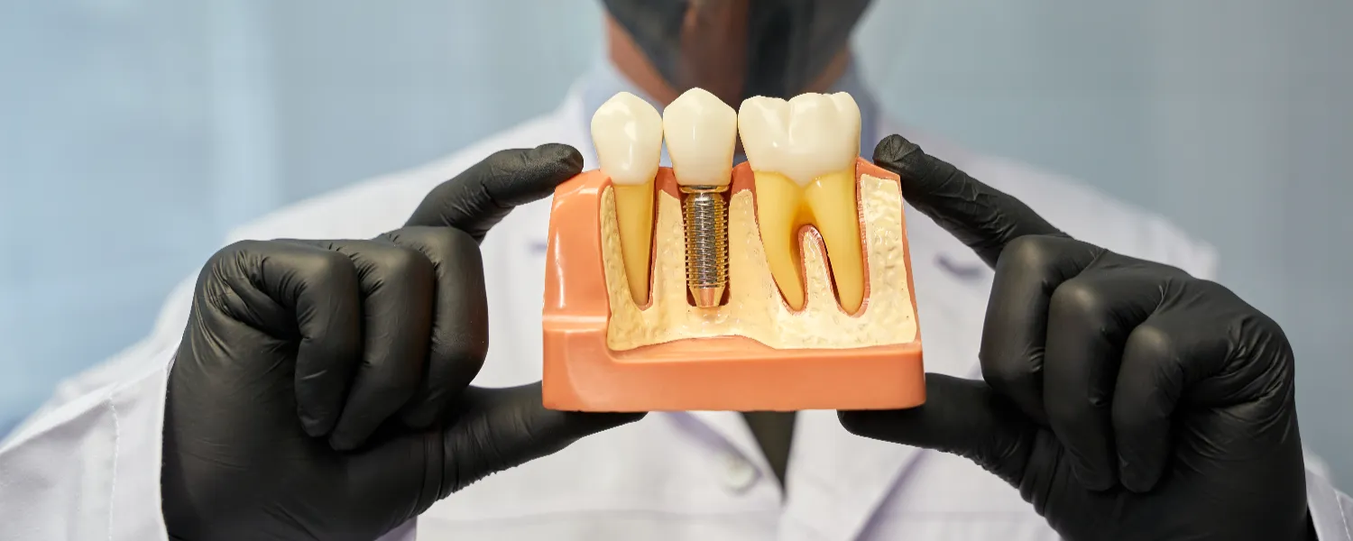 Bio zubni implantati