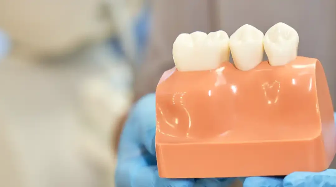 E-max ili cirkon? Kako odabrati idealan materijal za vašu zubnu krunicu