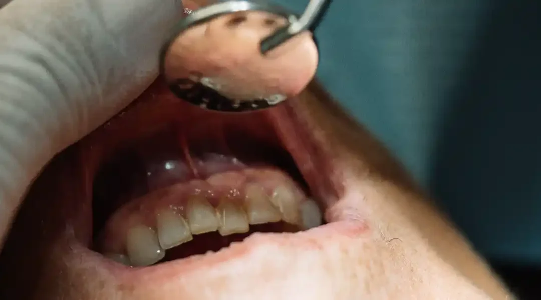 Periodontitis: Prepoznavanje, liječenje i sprječavanje