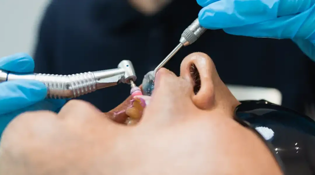 Pjeskarenje zubi i poliranje: razlike, indikacije, učestalost i sigurnost zahvata