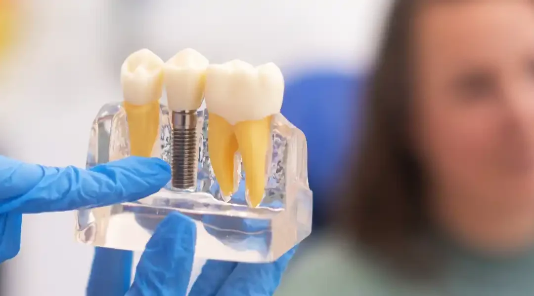 Zubni implantati i opće zdravlje: postoji li poveznica?