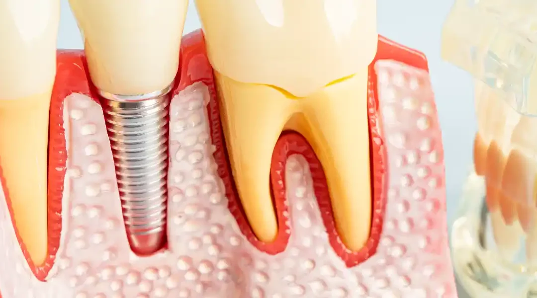 Zubni implantati i prehrana: Što smijete jesti prije i poslije zahvata