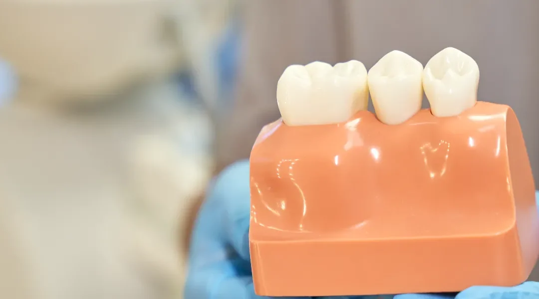 Krunice nakon endodontskog liječenja: nadogradnje i dugoročna prognoza