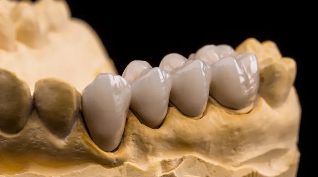 Dugoročna prognoza zubnih mostova: uzroci neuspjeha, protokoli kontrole i održavanje