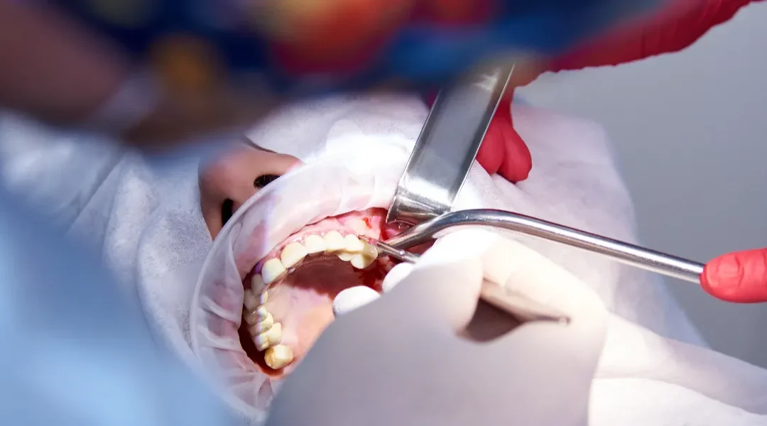 Oporavak nakon vađenja umnjaka – „dan po dan“: bol, otok, prehrana, higijena i povratak aktivnostima