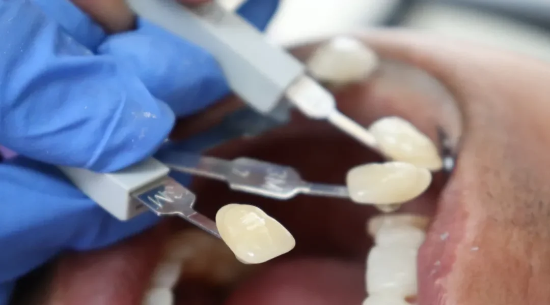 Privremene krunice: uloga u oblikovanju mekih tkiva, okluziji i estetskom ishodu