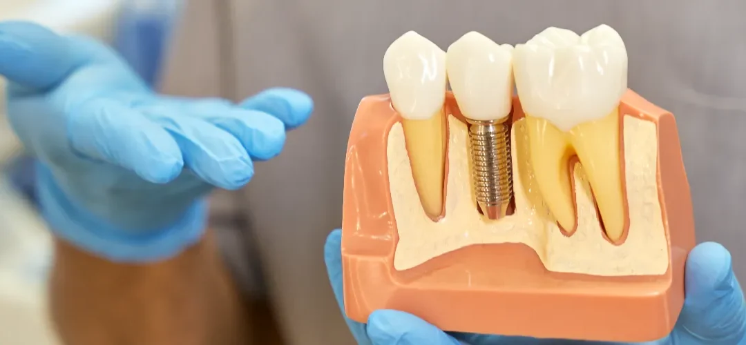 5 razloga zašto je zubni implantat najbolja dugoročna zamjena za izgubljeni zub