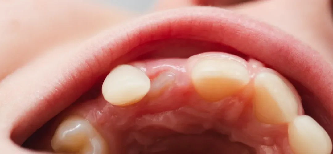 Mliječni zubi: pravilna higijena, prehrana i uloga roditeljskog nadzora