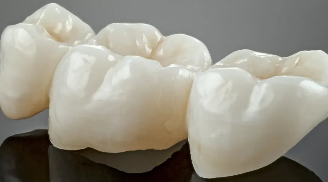 Zubni most na nedostatku jednog zuba