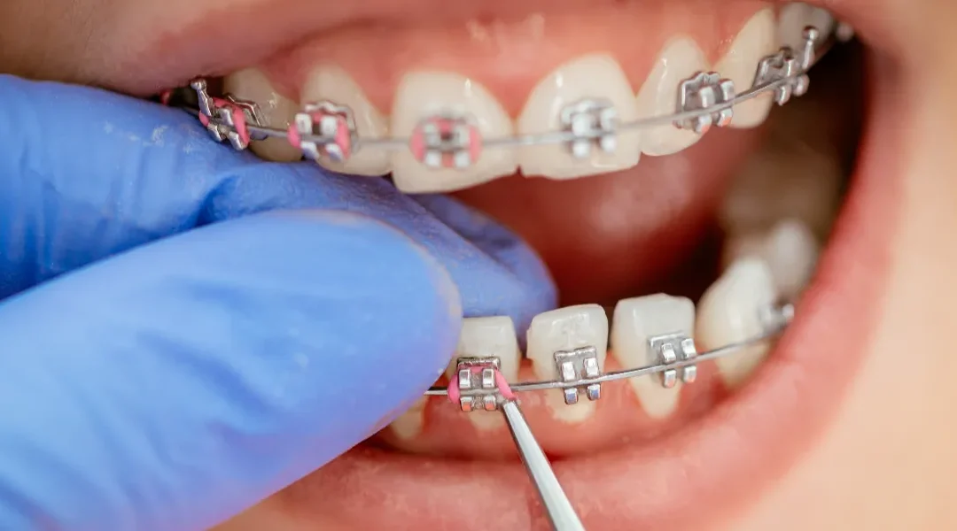 5 razloga kada je potreban pregled ortodonta