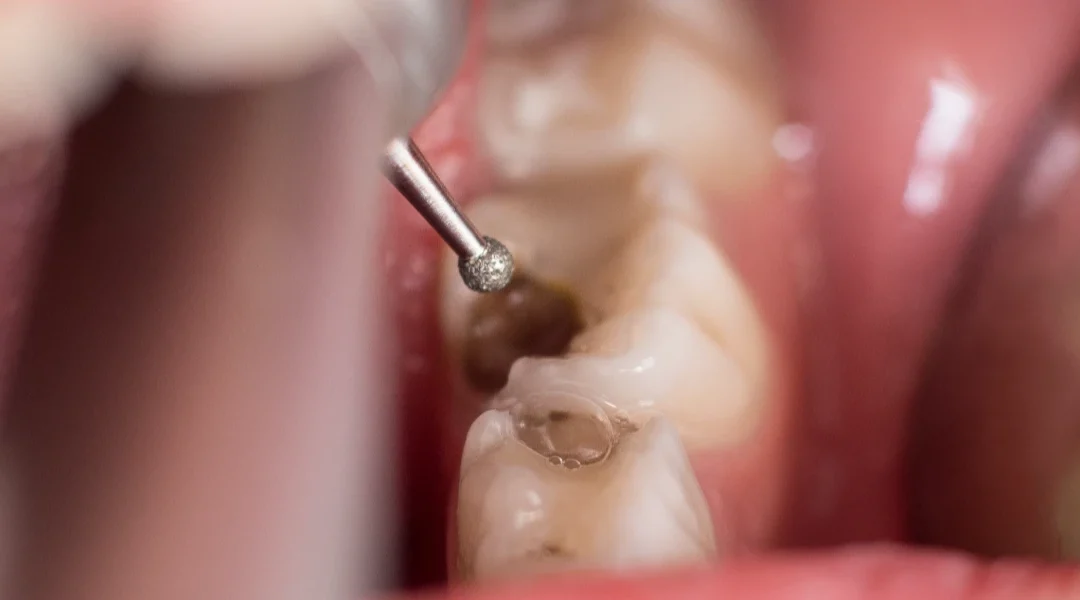 Suha alveola (alveolitis): rizični faktori, terapija i koliko traje bol