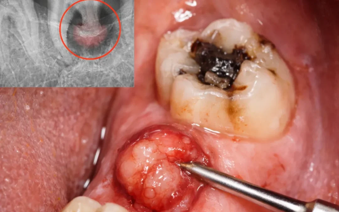 Granulom zuba: kada je dovoljan endodontski retretman, a kada je potrebna kirurgija