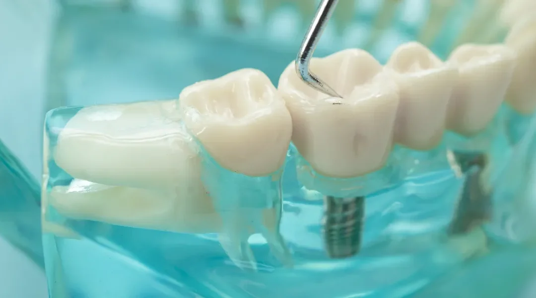 Most na dva zuba: kada je stabilno rješenje, a kada postoji rizik od preopterećenja nosivih zuba