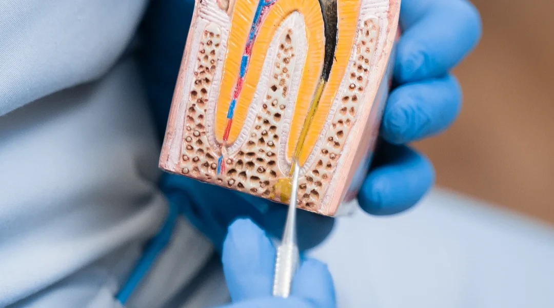 Vađenje korijena zuba: kada se radi odvojeno, koji su rizici i kako izgleda oporavak