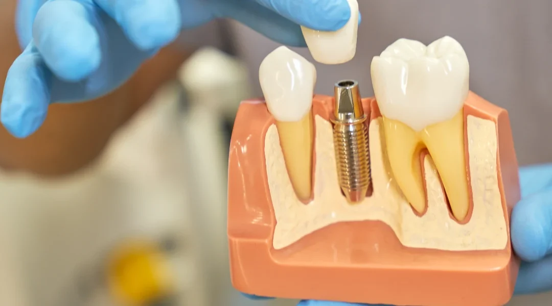 Zubni implantati: preduvjeti (kost, gingiva, opće zdravlje) i najčešći razlozi odgode zahvata