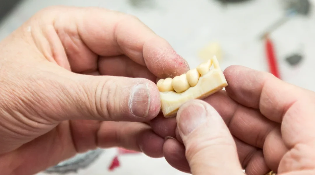 Zubni most: biomehanika opterećenja i kada je bolja opcija implantat umjesto mosta